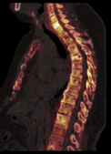 SJMC xSPECT-CT Bone Scan Imaging